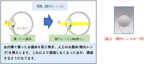 IOL【眼内レンズ】